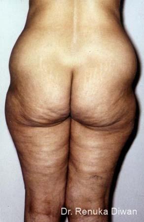 Liposuction: Patient 10 - Before 1