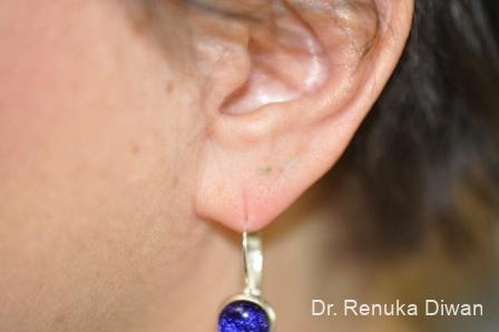 Earlobe Surgery: Patient 1 - Before 