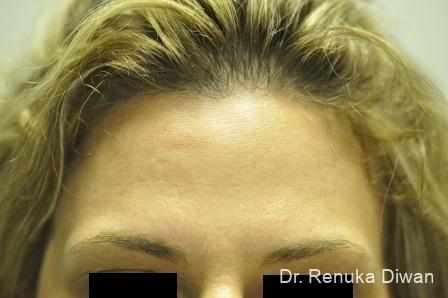 BOTOX® Cosmetic: Patient 19 - After 2