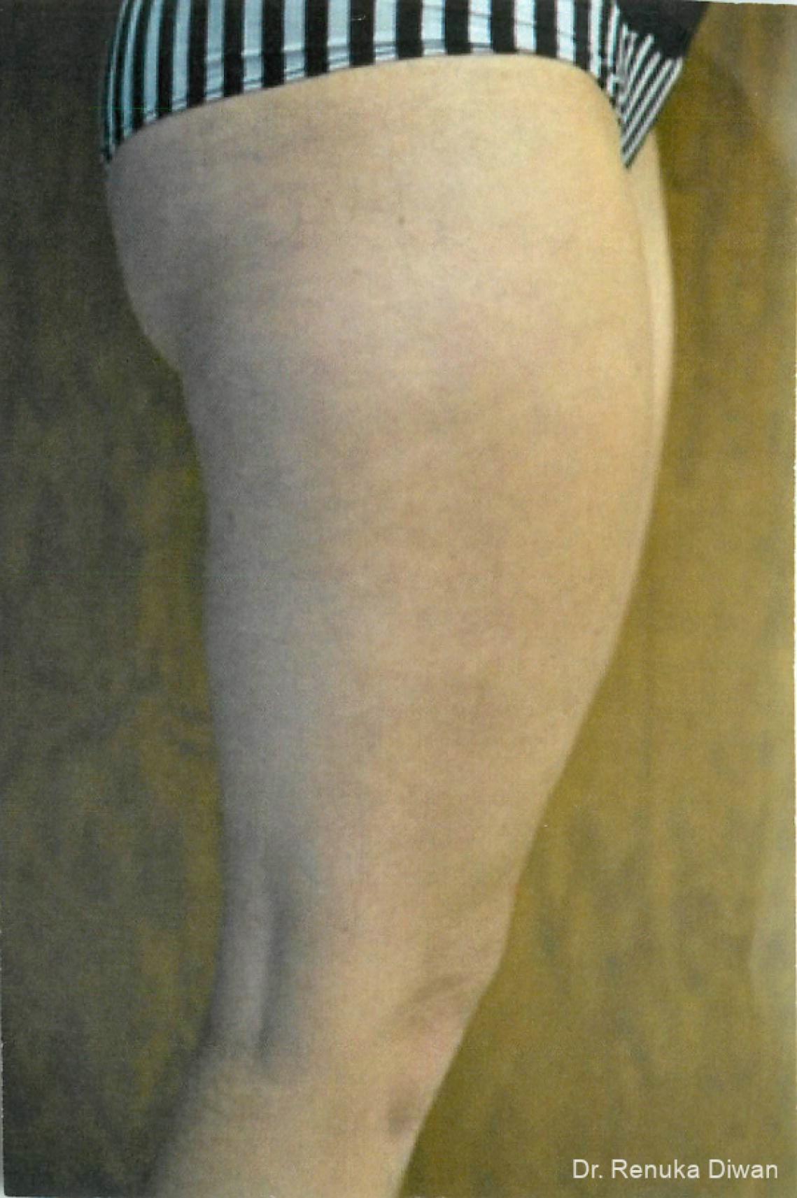 Cellulite Reduction: Patient 2 - After  