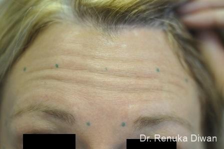 BOTOX® Cosmetic: Patient 12 - Before Image