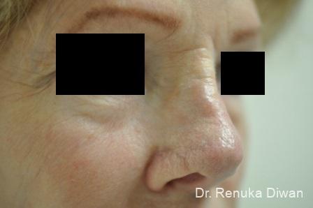 Non-Surgical Rhinoplasty: Patient 1 - After 4