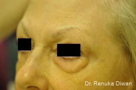 Blepharoplasty: Patient 6 - Before 