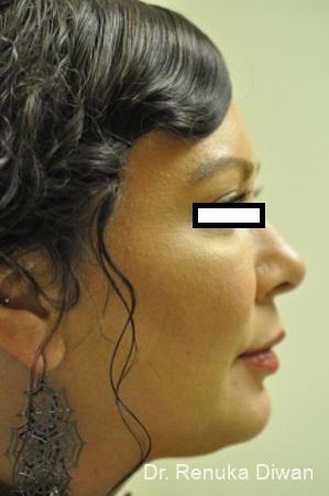 Chin Augmentation: Patient 3 - After  