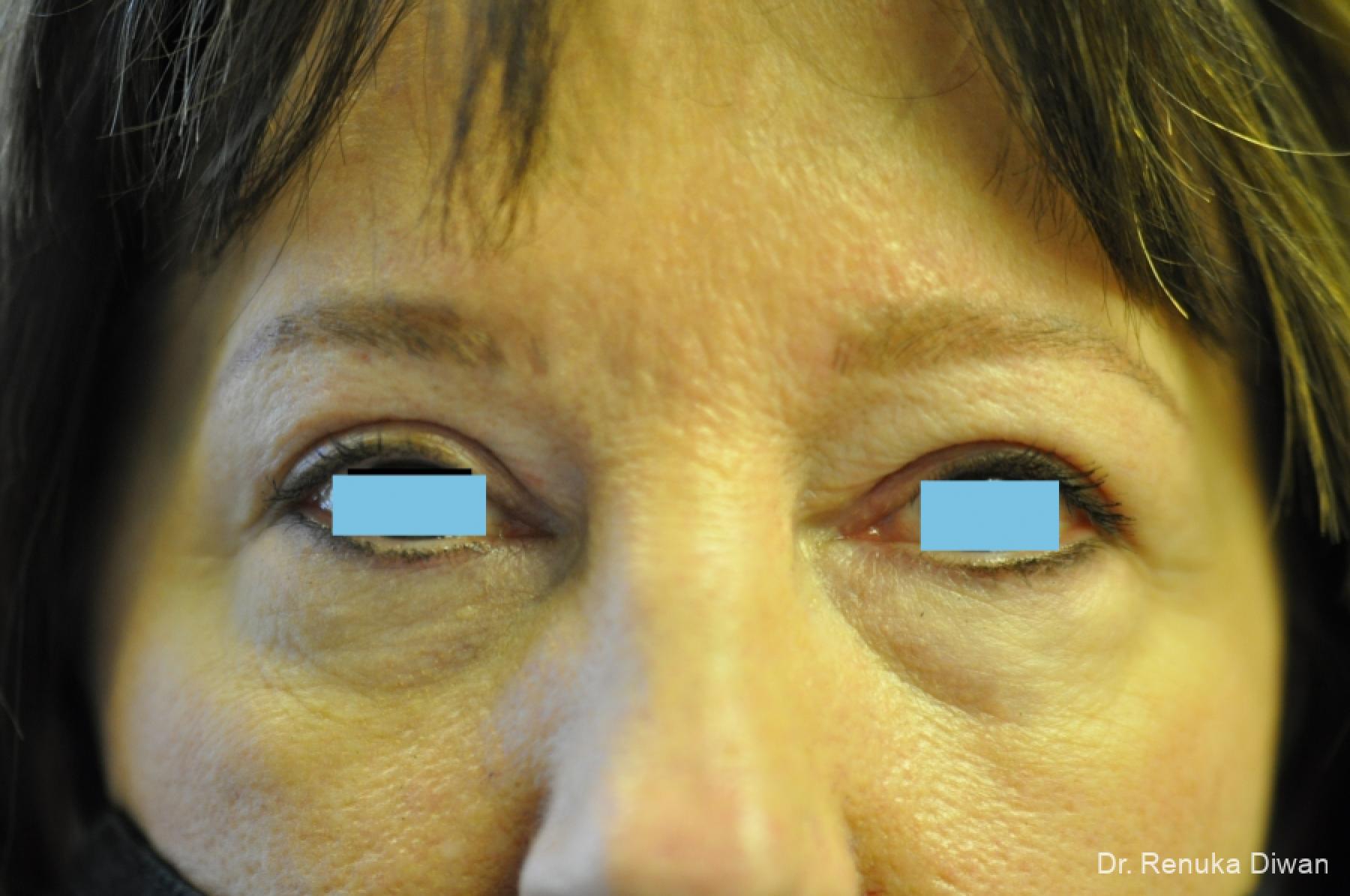 Blepharoplasty: Patient 3 - After  