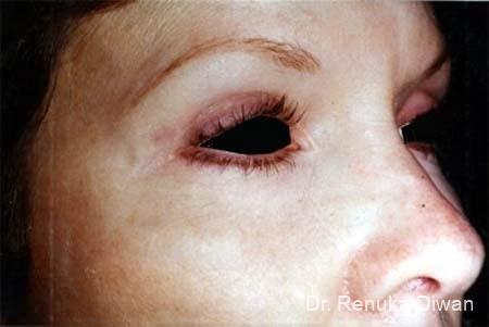 Blepharoplasty: Patient 5 - After  