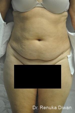 Liposuction: Patient 12 - Before 1