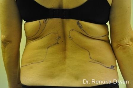Liposuction: Patient 5 - Before 
