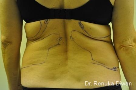 Liposuction: Patient 5 - Before 