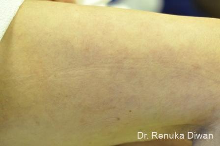 Veins On Legs: Patient 4 - After 1