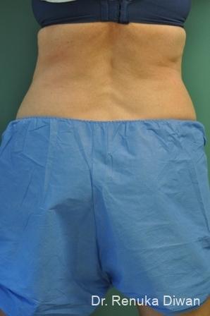 CoolSculpting®: Patient 1 - After  