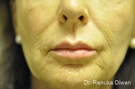 Lips And Mouth: Patient 14 - After 1