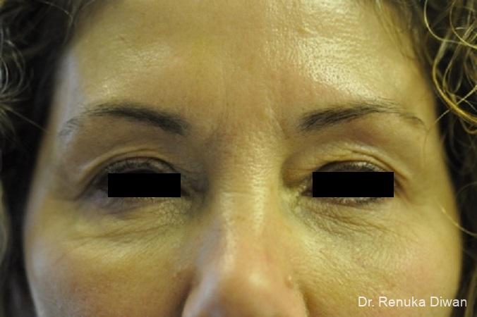 Dark Circles: Patient 16 - After 1