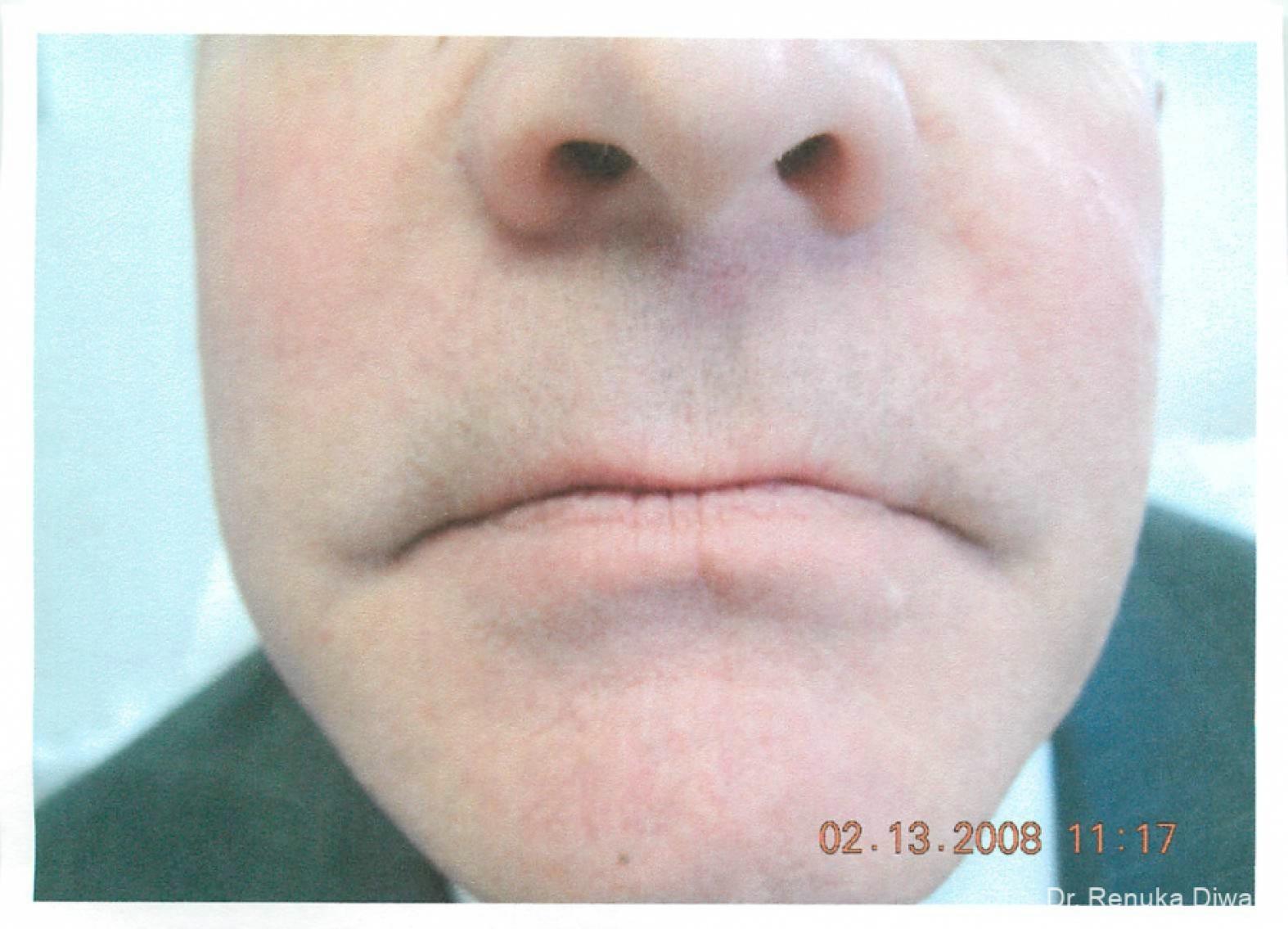 Smile Lines For Men: Patient 1 - After 1