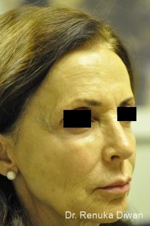 Non-Surgical Facelift: Patient 3 - After  