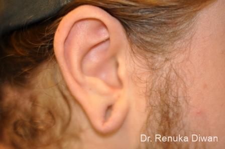 Earlobe Surgery: Patient 1 - Before 1