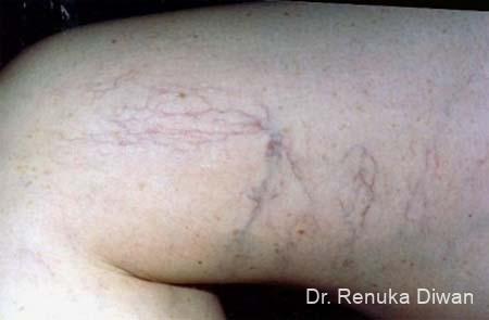 Veins On Legs: Patient 2 - Before 1