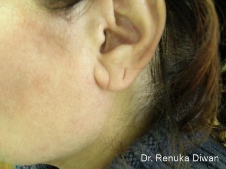 Earlobe Surgery: Patient 5 - Before 