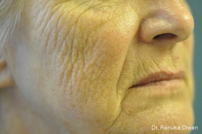 Laser Skin Resurfacing: Patient 7 - Before 