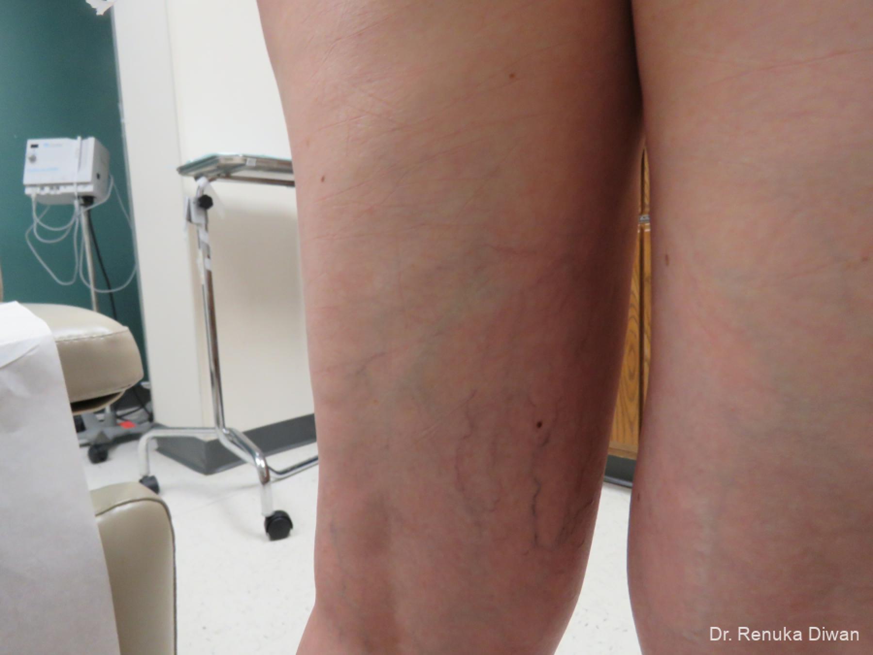 Veins On Legs: Patient 5 - Before 2