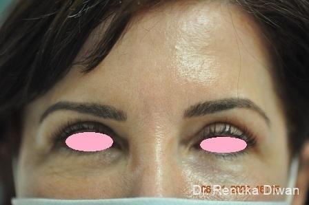 Blepharoplasty: Patient 2 - After  