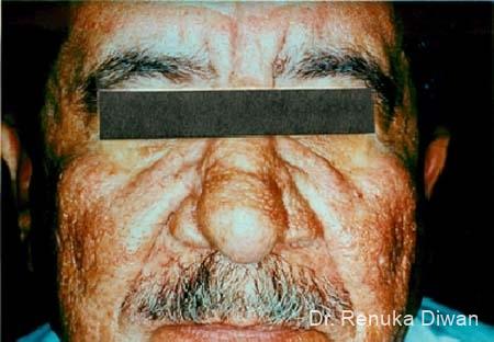 Lasers For Rhinophyma: Patient 1 - After  
