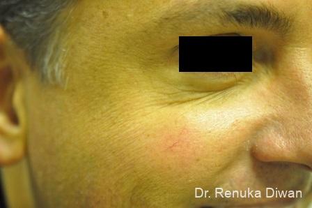BOTOX® Cosmetic: Patient 25 - After Image