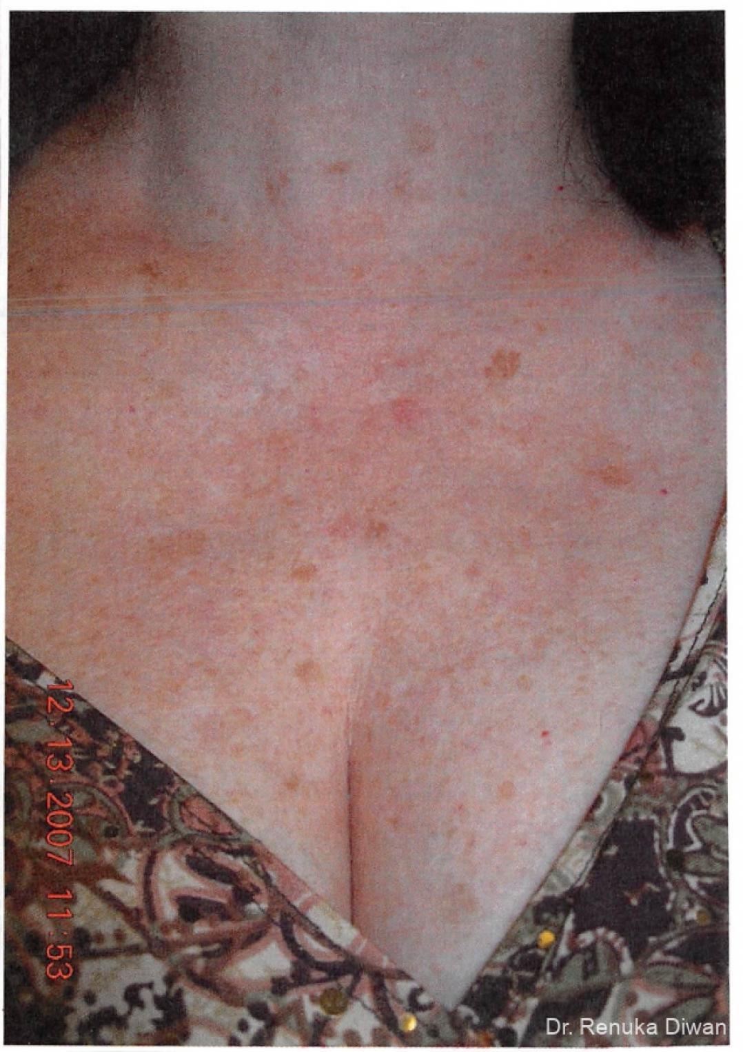 Lasers For Brown Spots: Patient 2 - Before 1