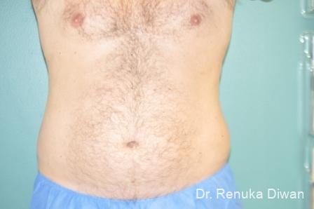 Coolsculpting For Men: Patient 1 - After 1