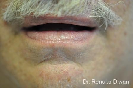 Laser For Veins And Redness For Men: Patient 7 - After 1