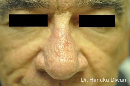 Laser Skin Resurfacing For Men: Patient 2 - After 1