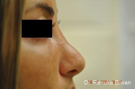 Non-Surgical Rhinoplasty: Patient 2 - Before 
