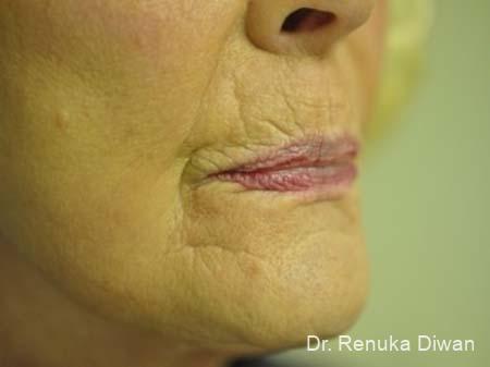 Lips And Mouth: Patient 8 - Before 