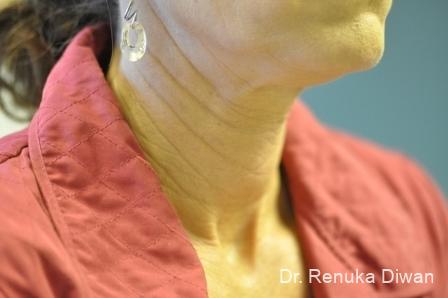 Neck Creases: Patient 2 - Before 