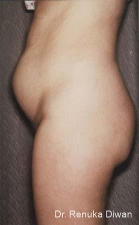 Liposuction: Patient 11 - Before 1