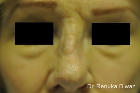 Non-Surgical Rhinoplasty: Patient 1 - Before 3
