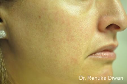 lasers spots brown before patient