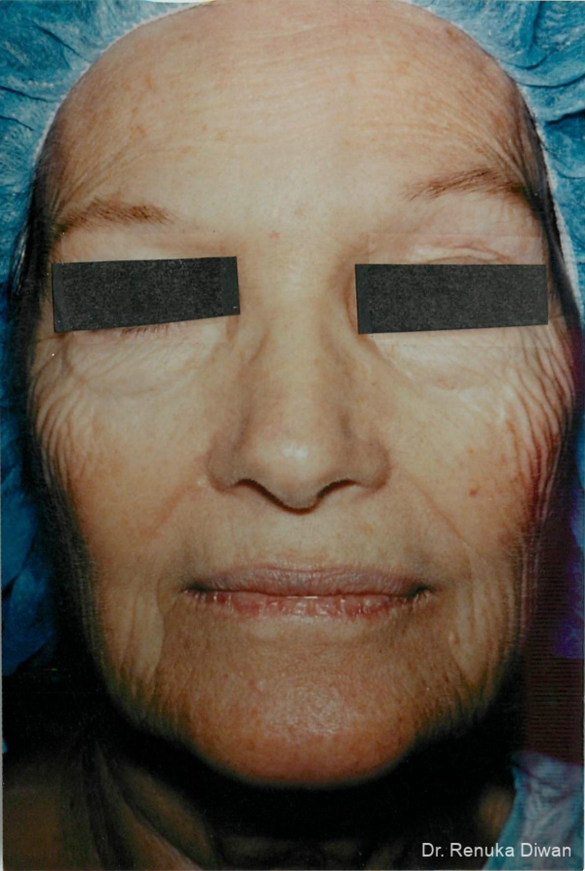 Laser Skin Resurfacing: Patient 5 - Before 1