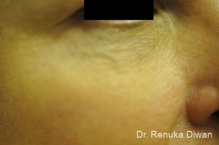Laser For Veins And Redness: Patient 14 - Before 1