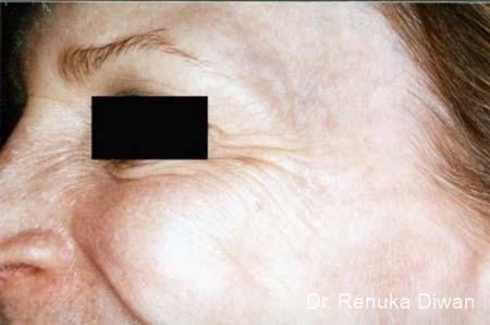 BOTOX® Cosmetic: Patient 19 - Before Image