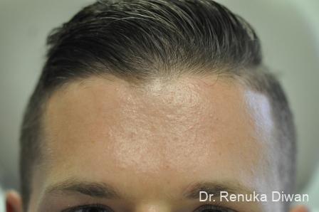 Chemical Peel: Patient 3 - Before 