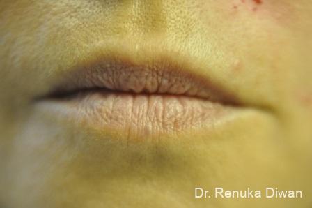 Lips And Mouth: Patient 2 - Before 