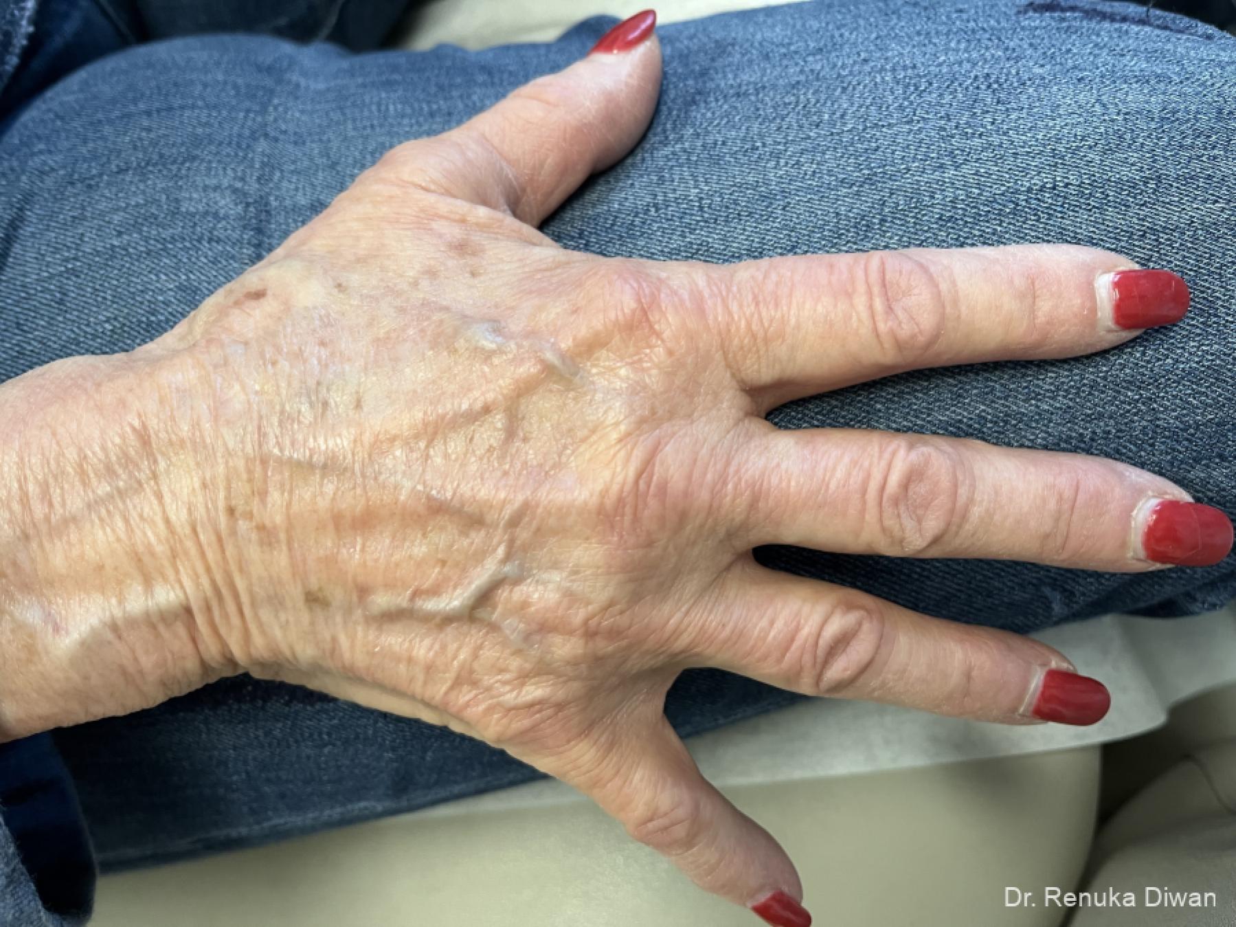 Hand Augmentation: Patient 1 - Before and After 2