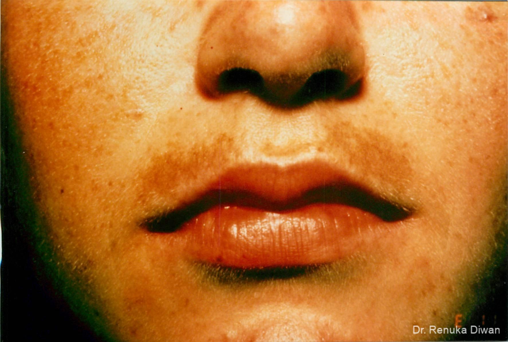 Lasers For Brown Spots: Patient 6 - Before 