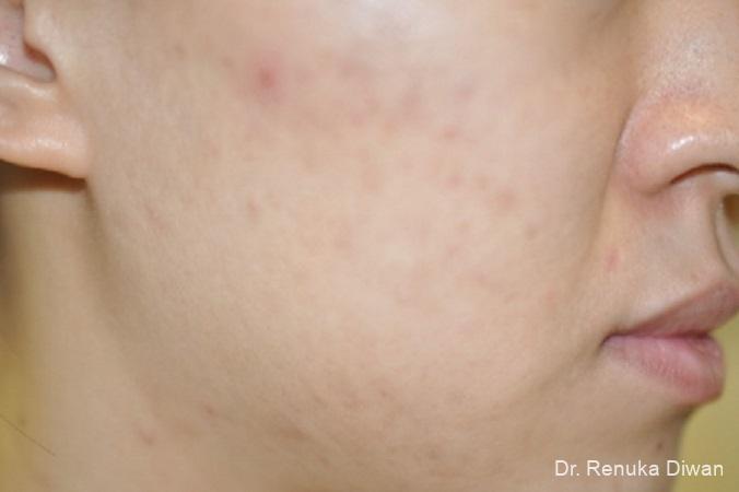 Chemical Peel: Patient 5 - Before 