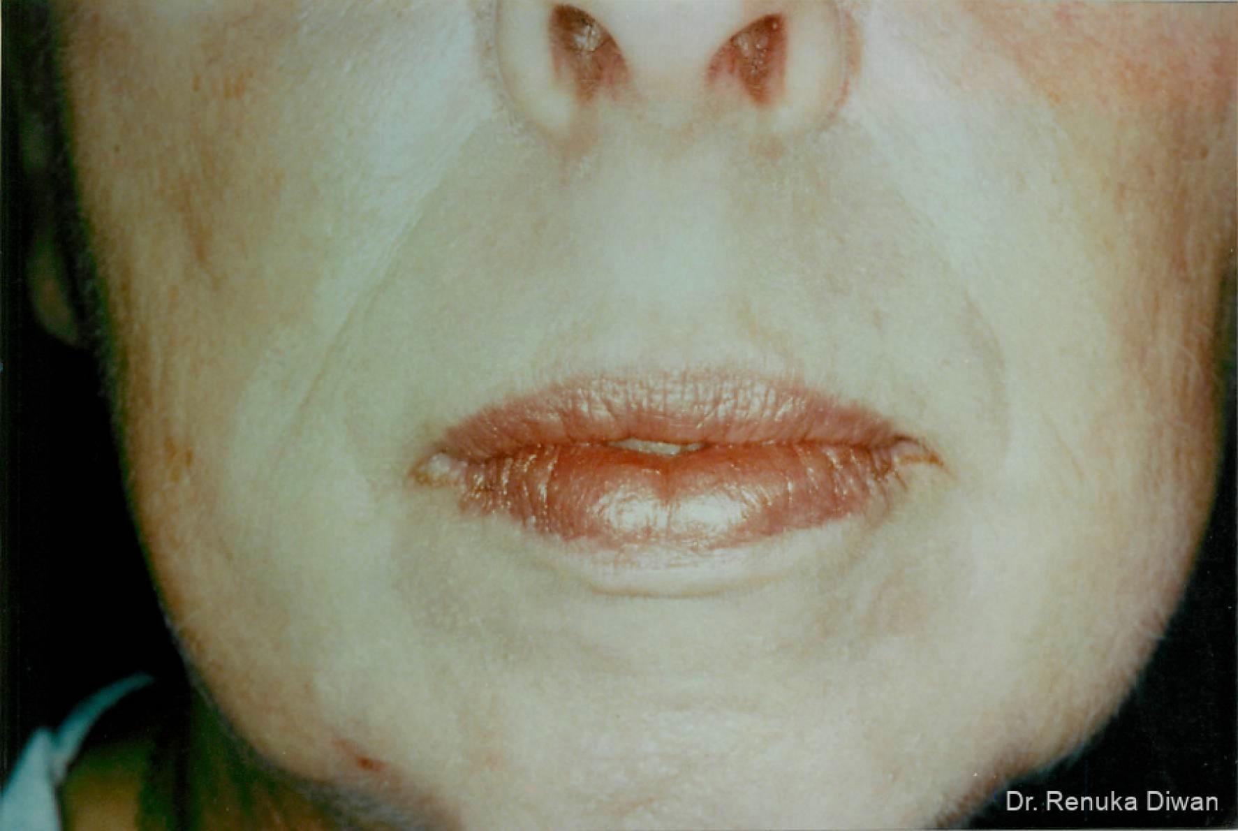 Laser Skin Resurfacing: Patient 4 - After  