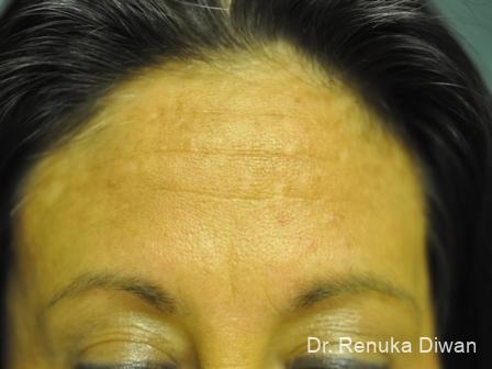 BOTOX® Cosmetic: Patient 13 - Before 1