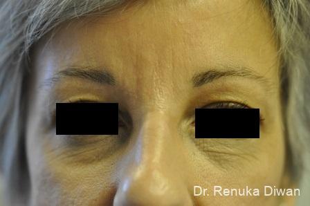 BOTOX® Cosmetic: Patient 4 - After 1
