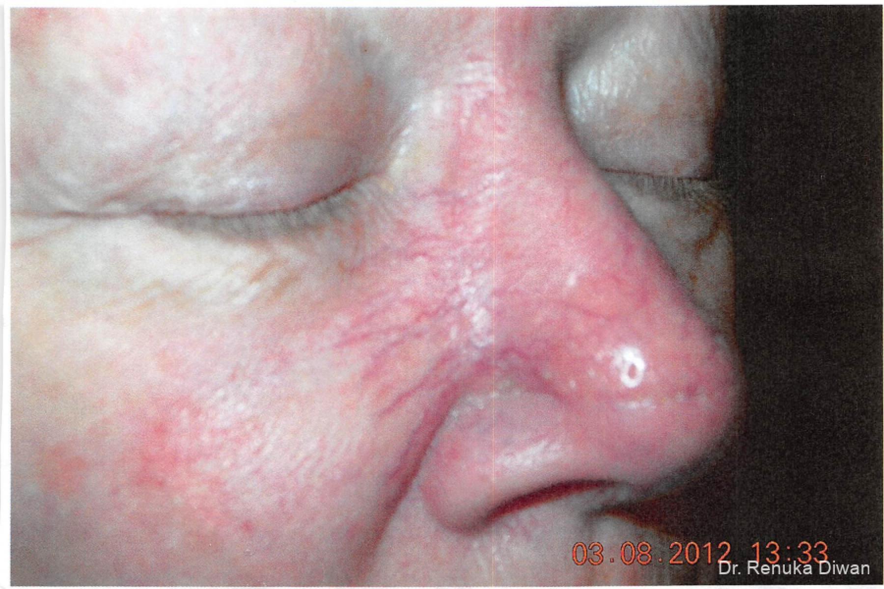 Laser For Veins And Redness: Patient 14 - Before 1