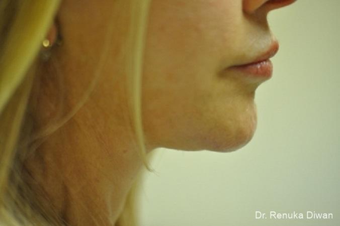 Chin Augmentation: Patient 4 - After  